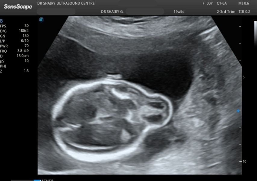 Level 2/ Anomaly scan Pregnancy Ultrasound in Gurgaon